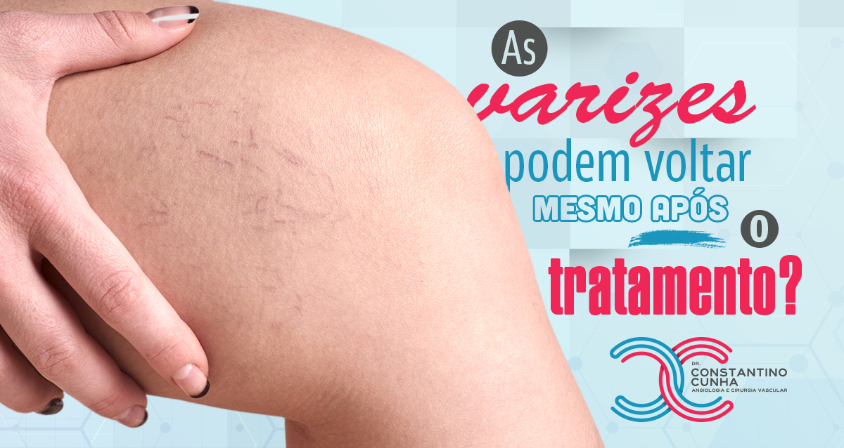 As varizes podem voltar mesmo após o tratamento?