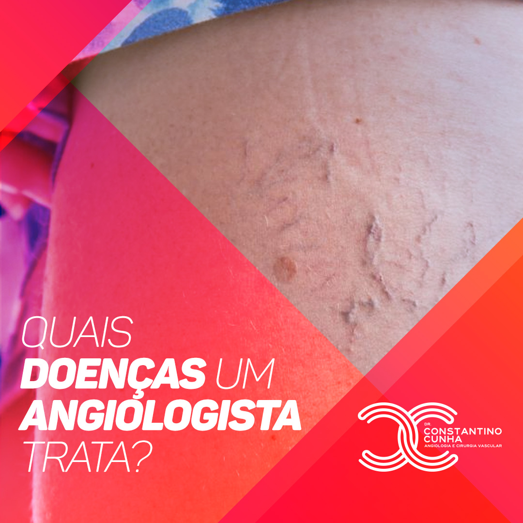 Quais doenças um Angiologista trata?